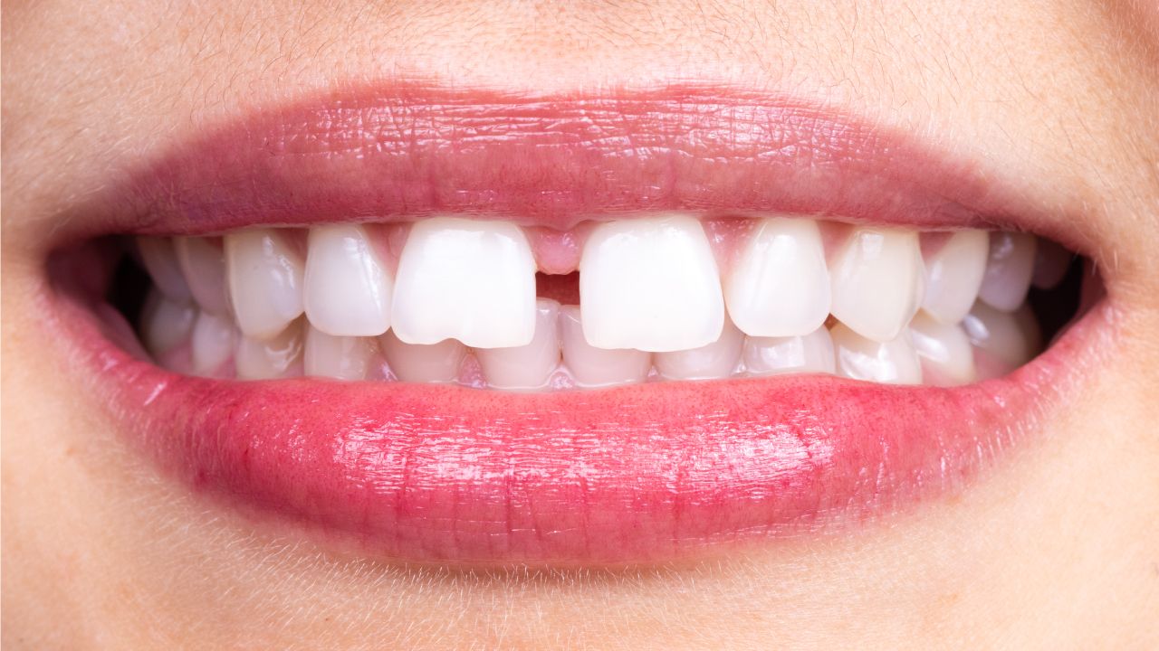 Visible Tooth Gap Smile