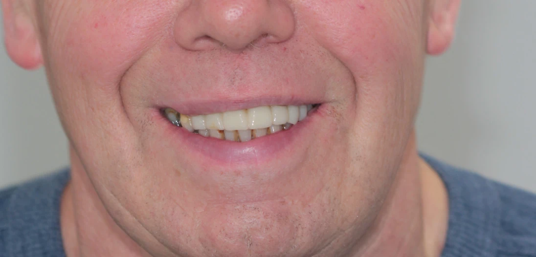 What Are Dental Implants? A Complete Guide