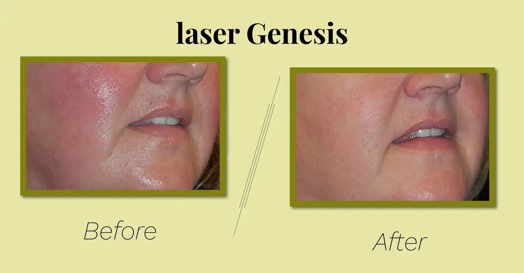 Photo Courtesy of Rick Green, MD for baseline laser genesis
