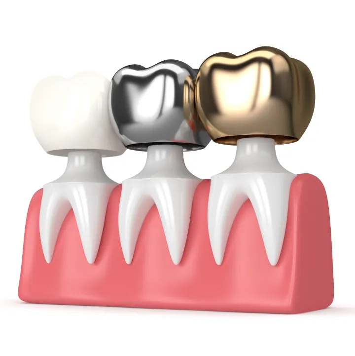 Dental Crowns