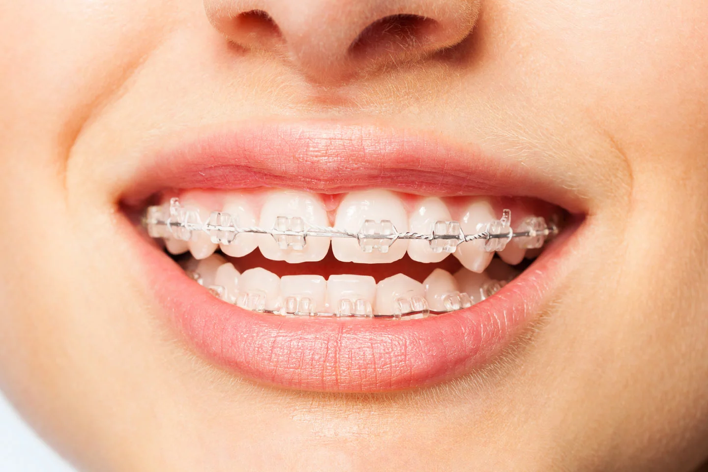 Do braces hurt? What to expect -Add Smile Dentistry