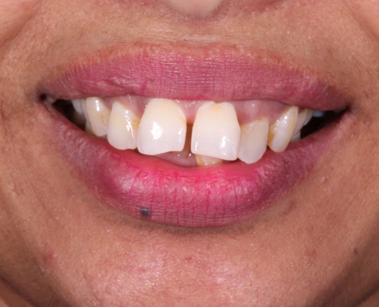 Before Invisalign
