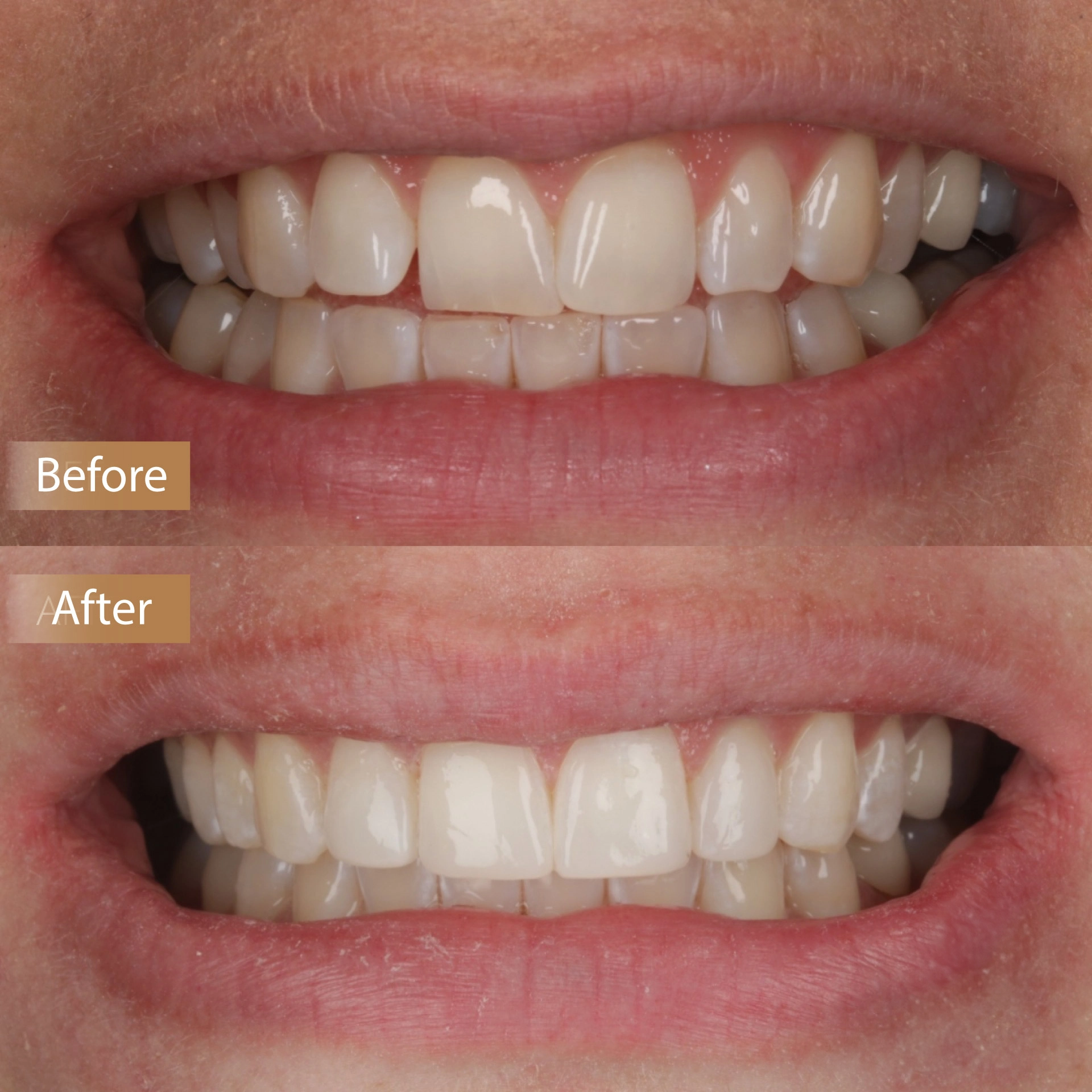 Teeth Straightening image