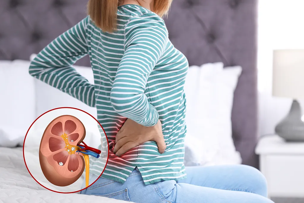 The Truth About Kidney Stones – What Nobody Tells You