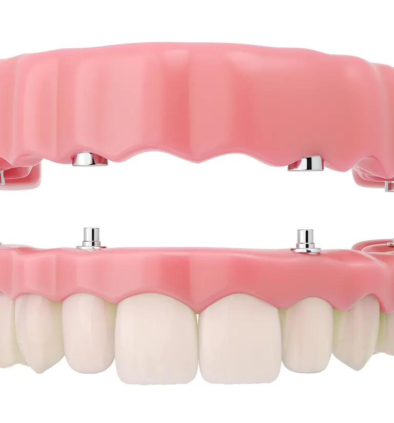 Implant Retained Dentures