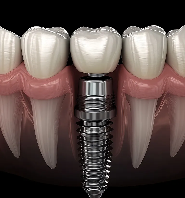 Do Dental Implants Feel and Function Like Natural Teeth?