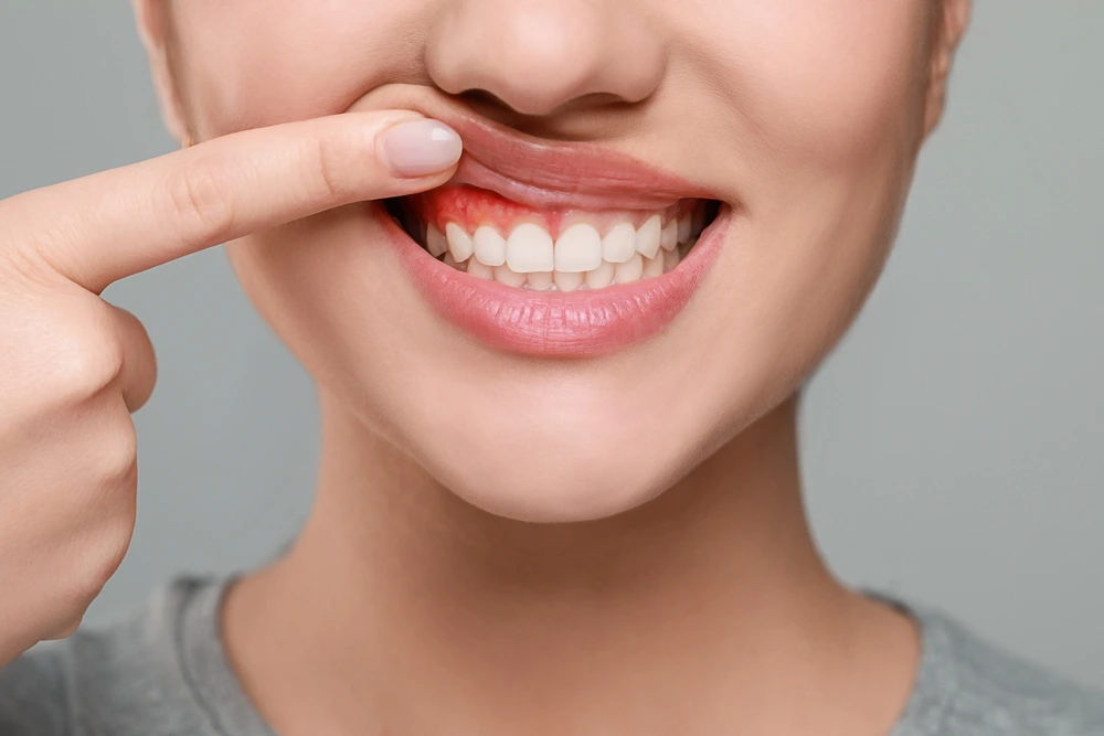 Gum Health