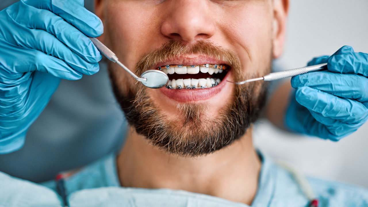 Braces Treatment
