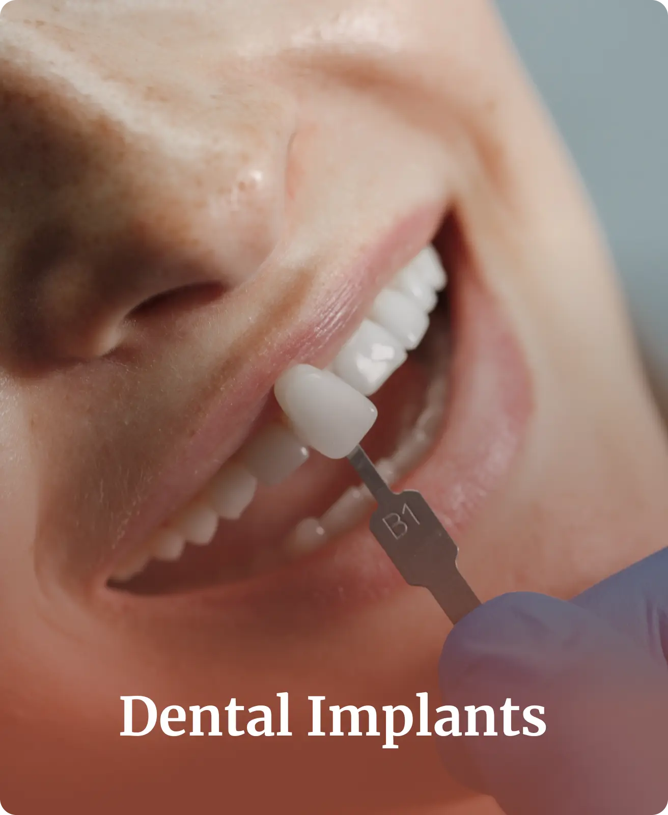 What Are 5 Important Facts About Dental Implants?