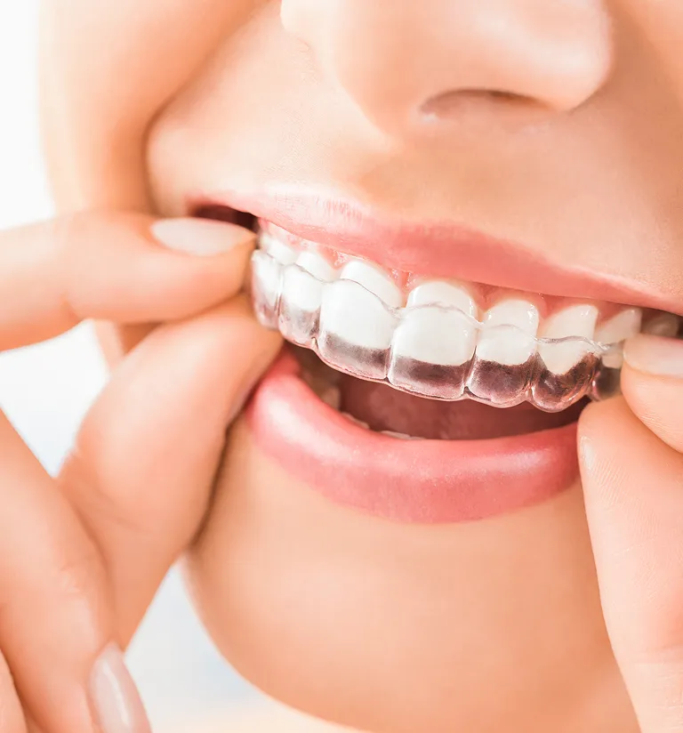 Discreet Treatment, Dramatic Results
Imagine having teeth that are straight, balanced, and healthy. Many think the only way to reach this new smile is by turning to traditional metal braces. We think differently. We throw out the painful brackets and wires and offer an alternative route to an ideal smile—Invisalign®. Using clear aligners, whether a teen or an adult, we can straighten your teeth without anyone noticing! Results are just as dramatic and can even be offered in less time than some traditional treatment plans. We offer Invisalign in Schaumburg and Norridge, IL to ensure you not only feel confident in your final smile, but throughout your orthodontic treatment as well.

Our skilled team of dentists offers comprehensive orthodontic treatments in our one, state-of-the-art location. A certified Invisalign Silver Provider, Dr. Agnieszka (Agnes) Kucharska also completed a two-year orthodontic program at Progressive Ortho Seminars and became certified in a variety of other orthodontic solutions as well. Trusted authorities in orthodontics, our team can provide the customized treatment solutions your teeth and your confidence need. Find out if the noticeable results you’re searching for can be found through barely visible Invisalign aligners!