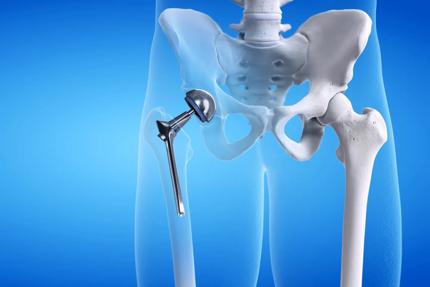 Hip Replacement