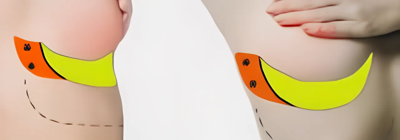 Chest Wall Perforator Flap Reconstruction