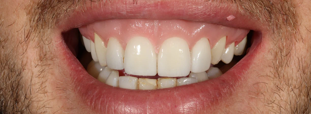 Porcelain Veneers