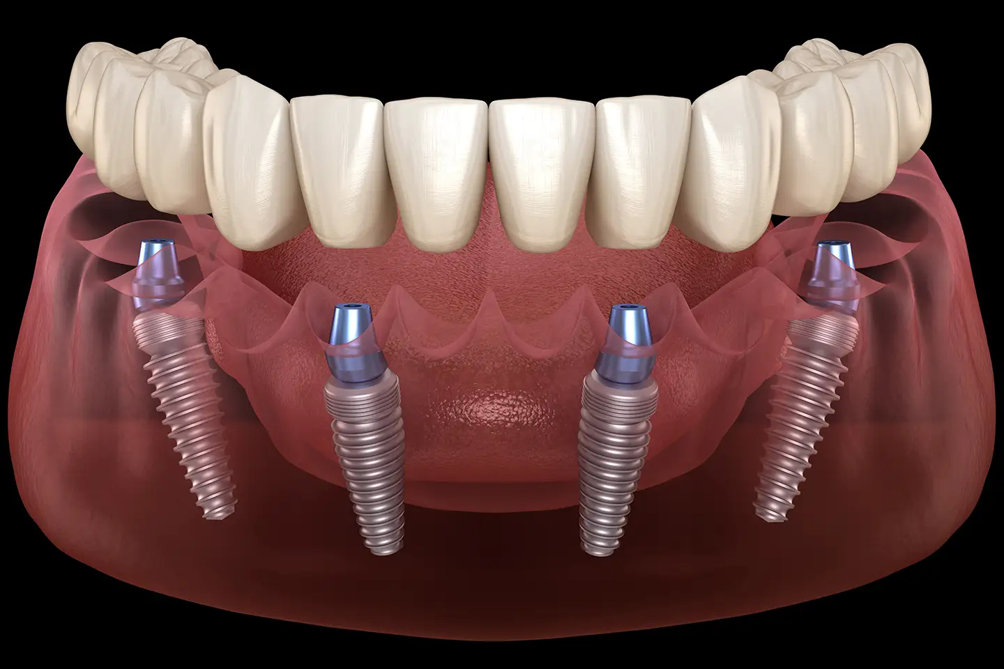 All-On-4 Dental Implants are Available at Ripon Dental
