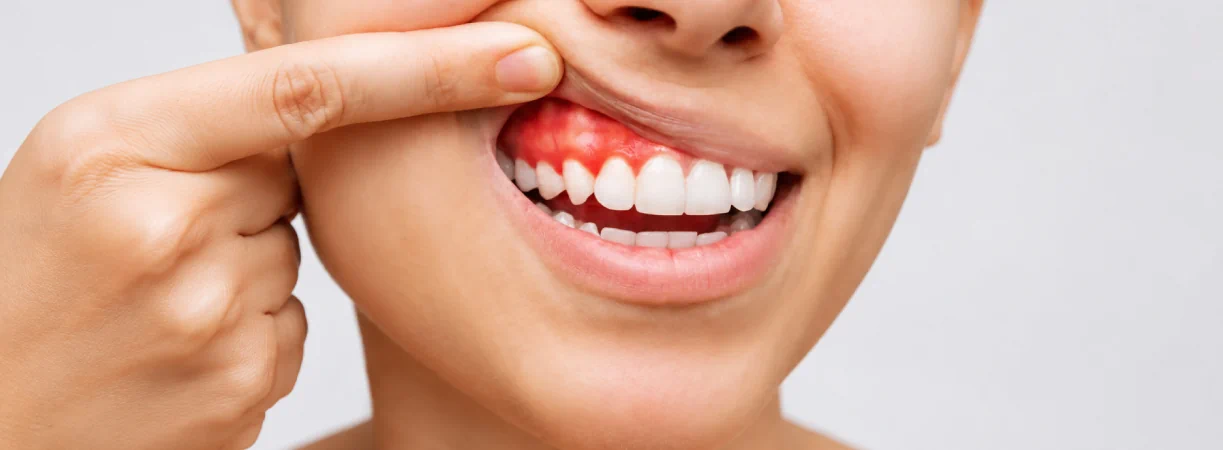 Periodontal Treatment