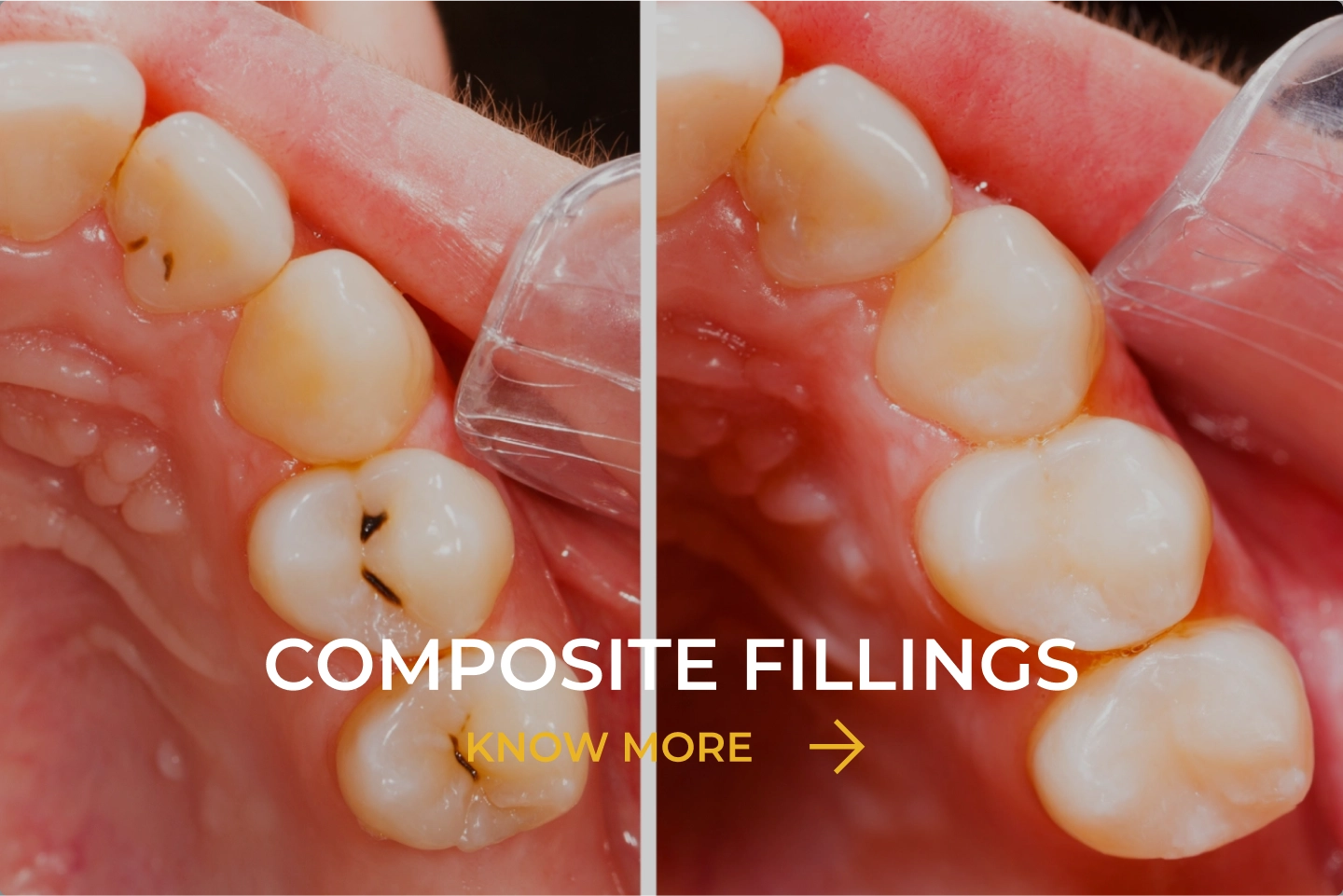 Composite Fillings image