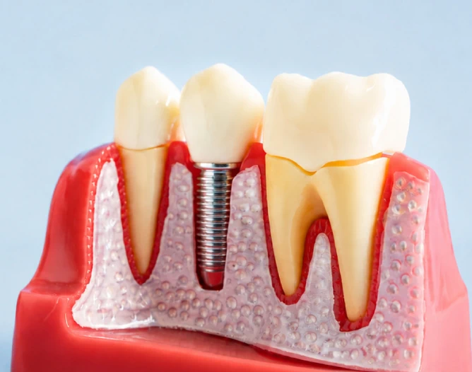 Implant Dentistry