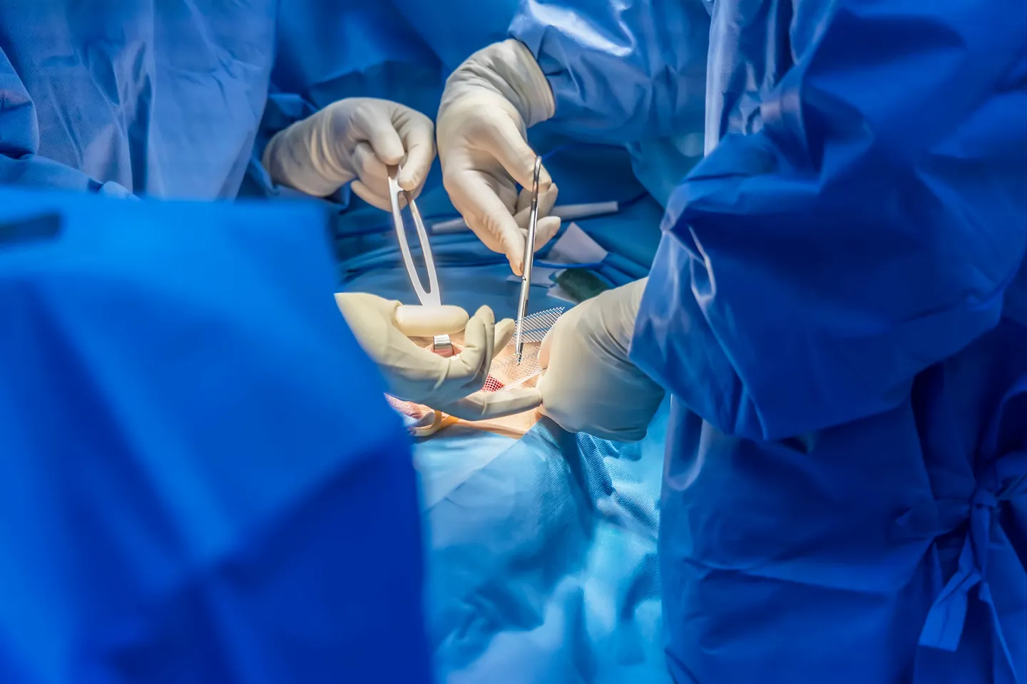 Hernia Surgeries (Laparoscopic /open)