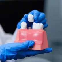 What’s Involved in Getting a Single Tooth Implant in Corby?
