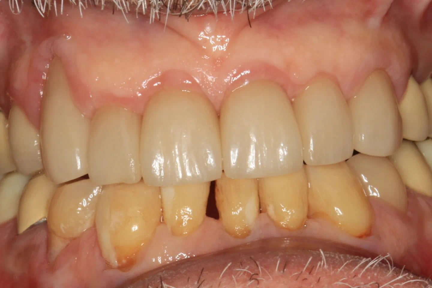 Before aesthetic crown treatment