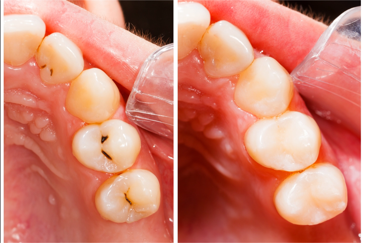 Composite Fillings