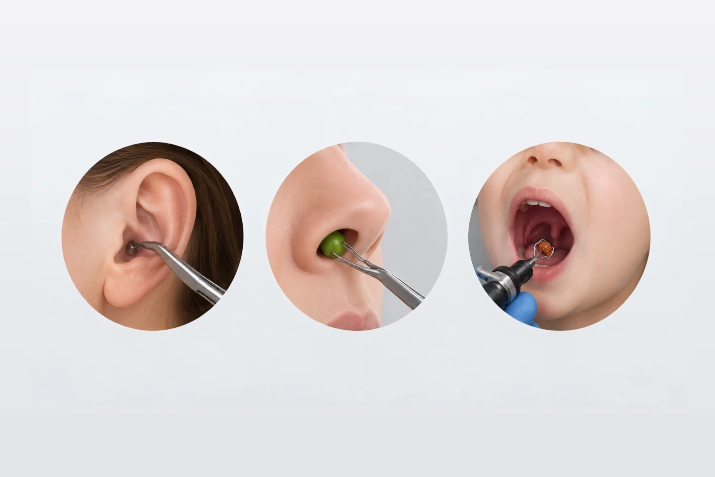 Foreign Body Removal from Ear, Nose and Airway
