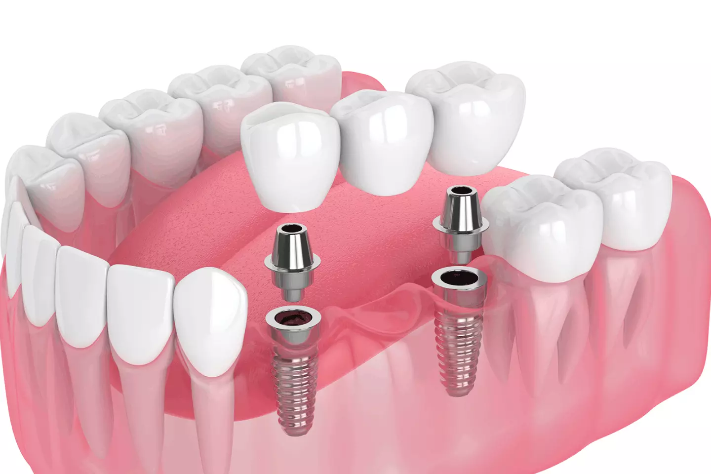 Implant-Supported Bridges | Delight Dental Studio