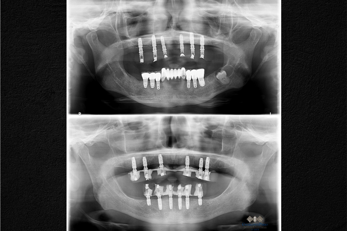 How Much Do Full Mouth Dental Implants Cost?