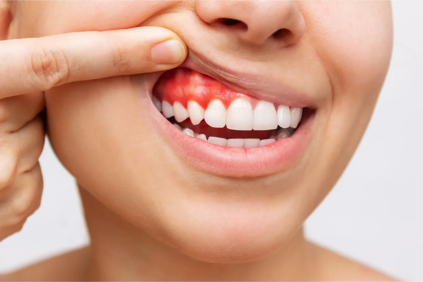 What Is Gum disease?