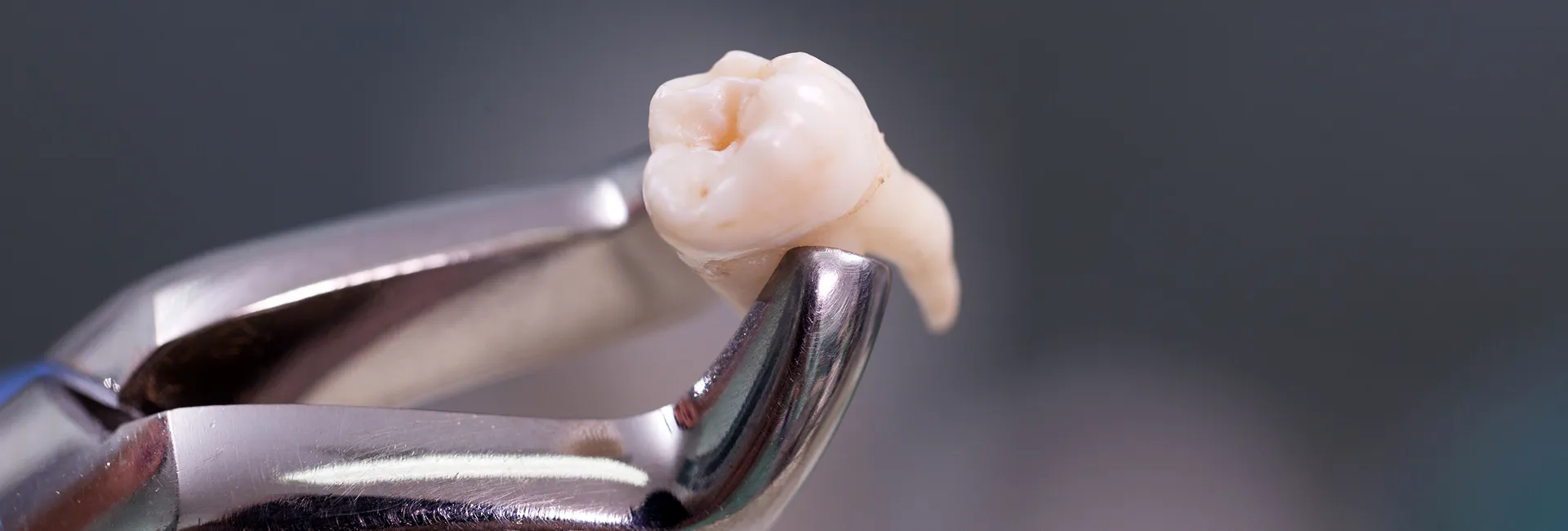 Tooth Extractions