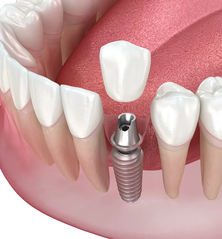 What to Expect After Getting Dental Implants: Recovery, Care, and Healing Timeline