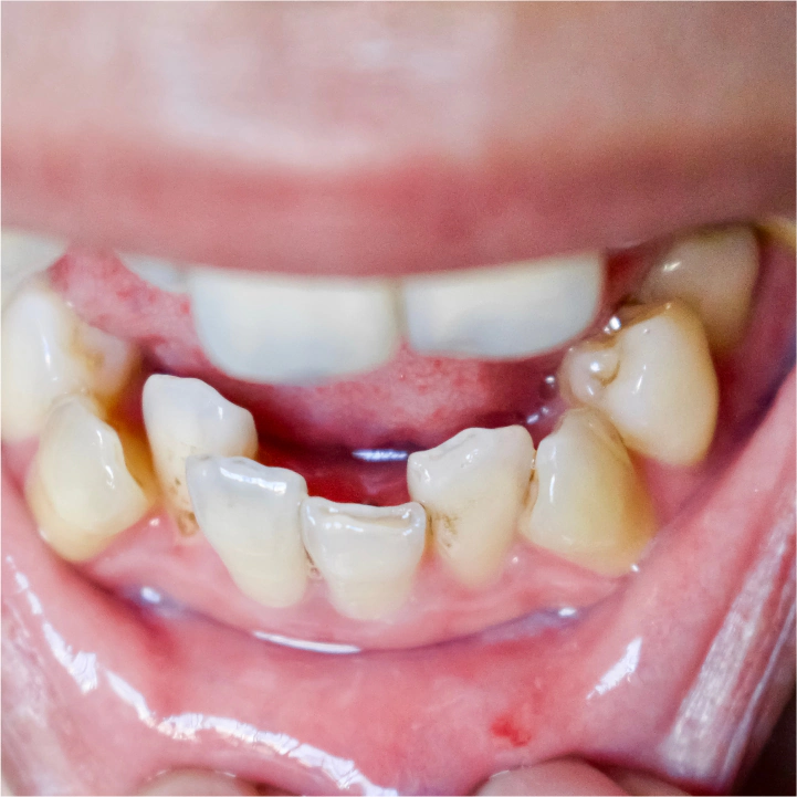 Malocclusion