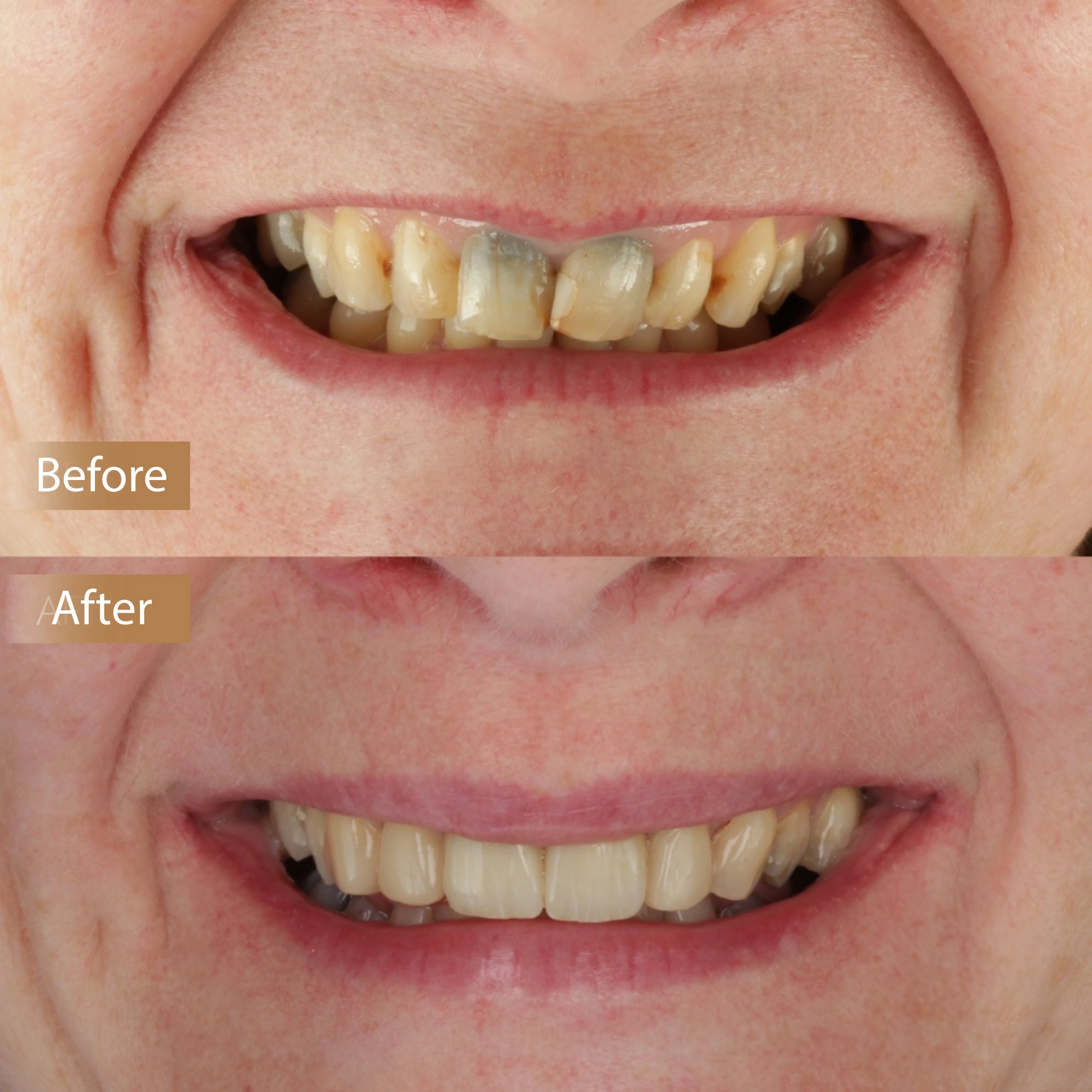 Veneers Restoring Discoloured Teeth image