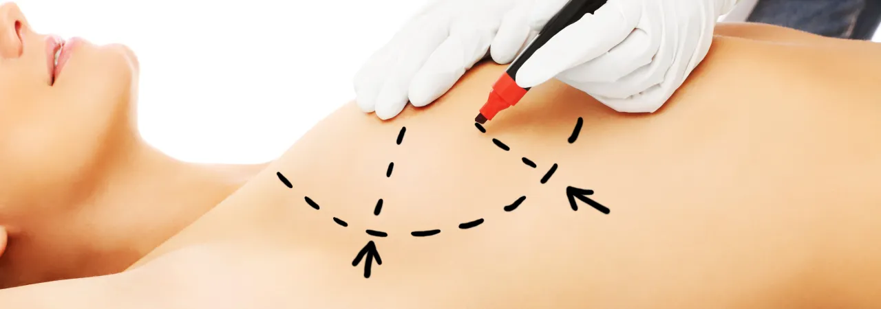 Illustration showing implant-based breast reconstruction.