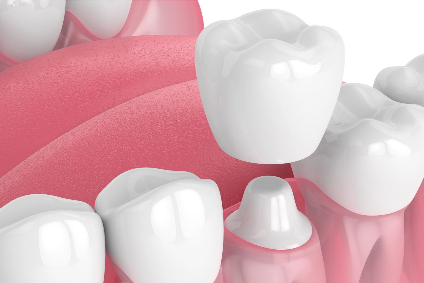 CEREC Crowns: A Quick Fix When You Need It Most