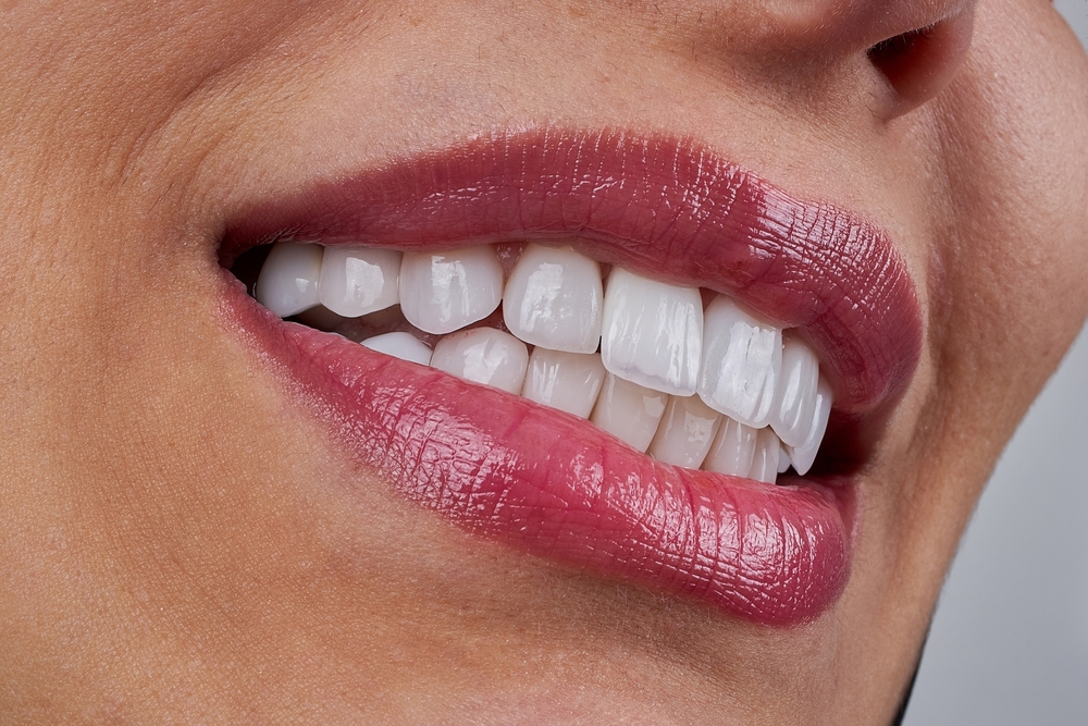 Veneers
