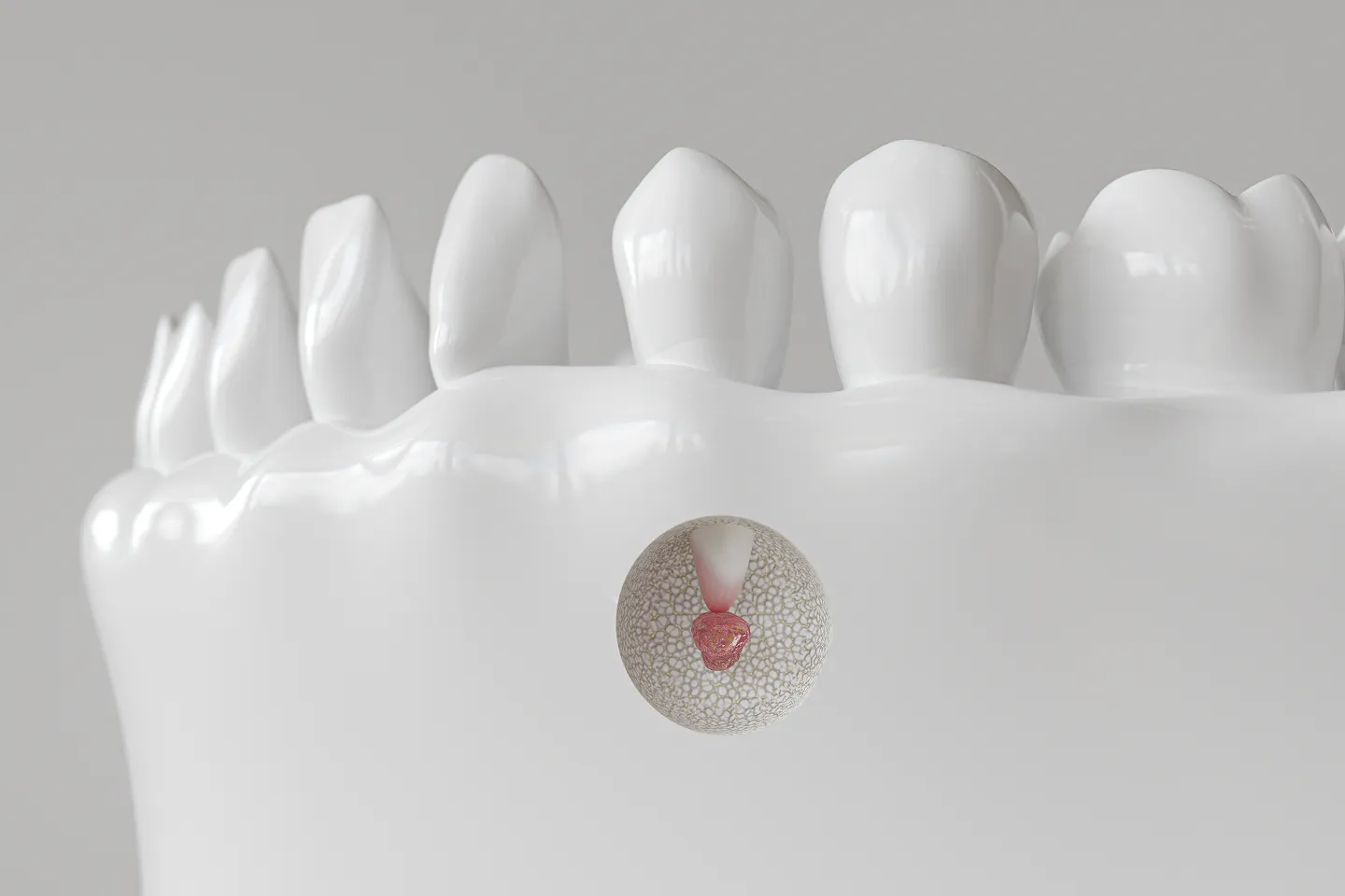 Apical Surgery