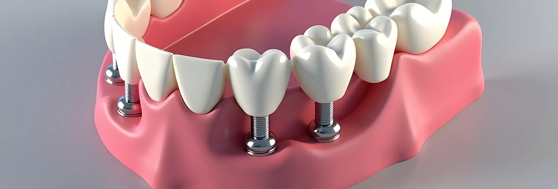 Implant Dentistry