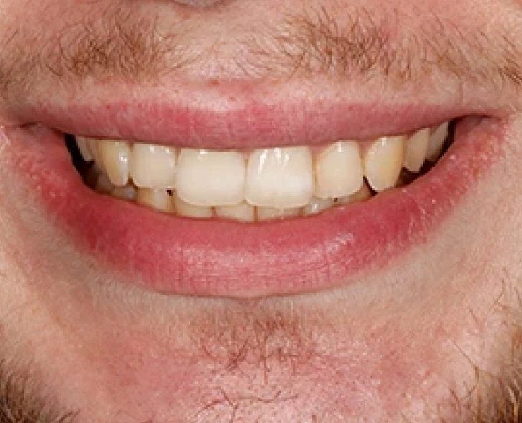 Teeth Case 2
