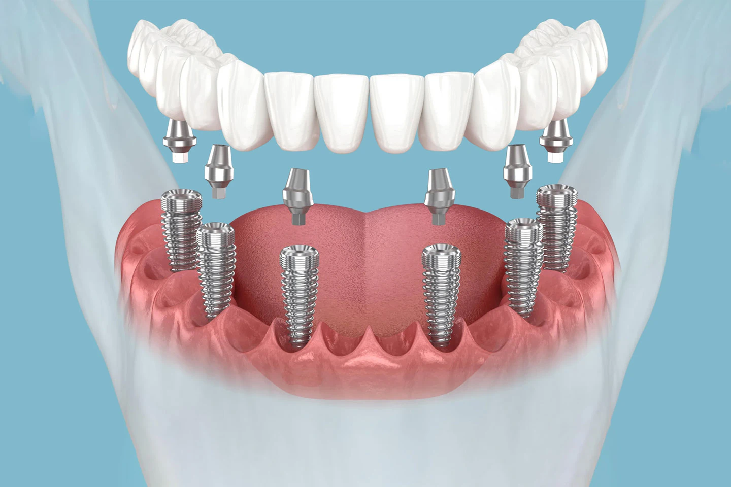All-On-6 Dental Implants