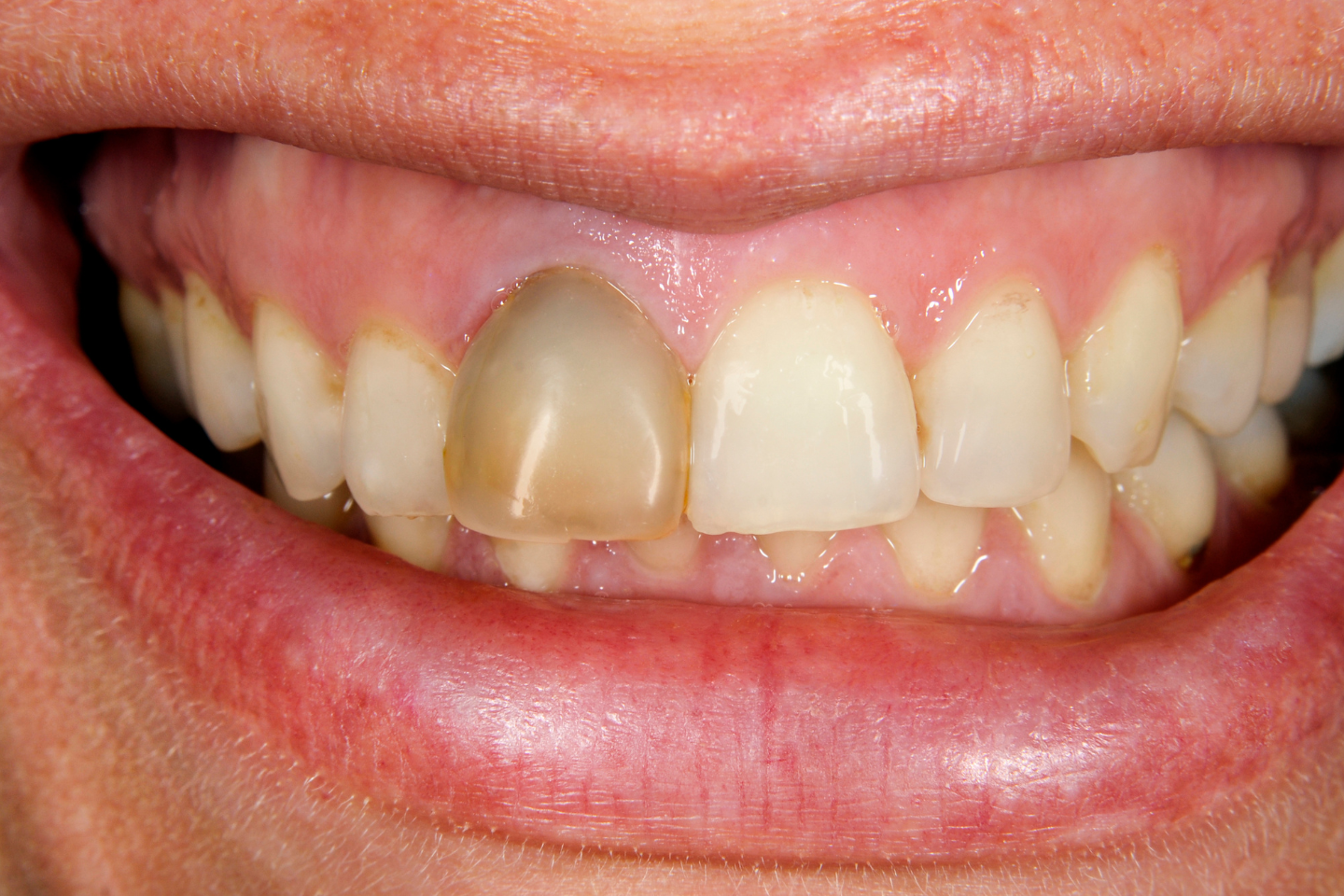 Icon showing a single shaded tooth turning into a bright white tooth with a sparkle.
