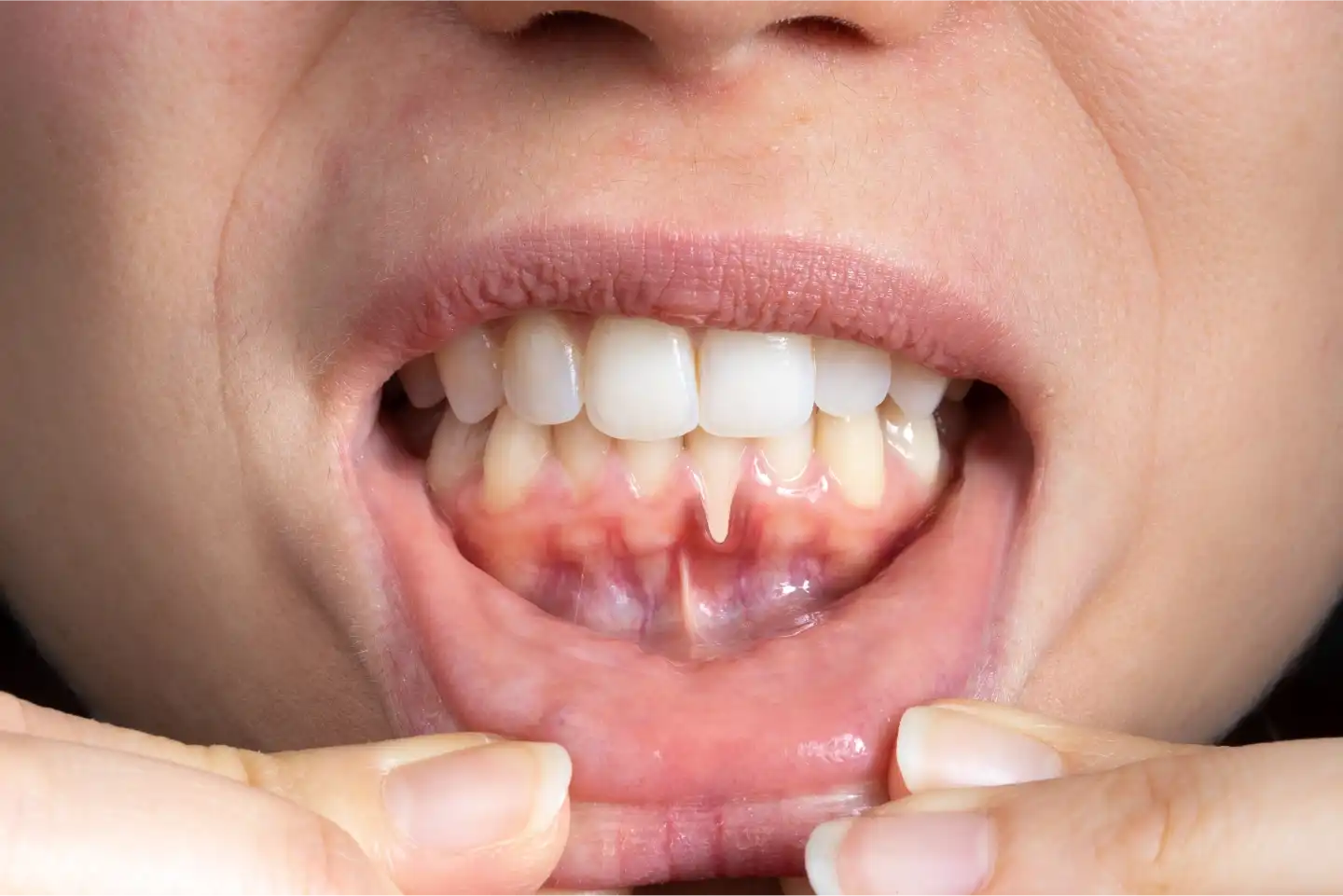Unexpected Symptoms of Gum Disease