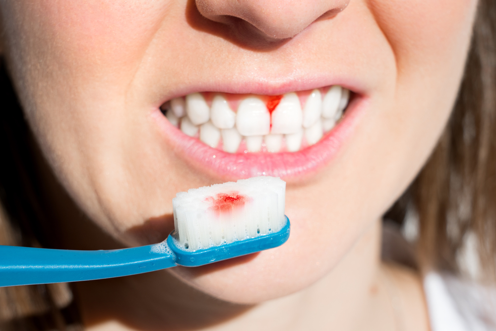 Gums Bleeding
