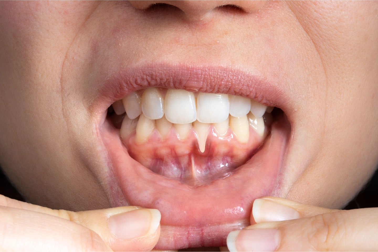 Concept of Gum Recession | Dentist in North Aurora IL
