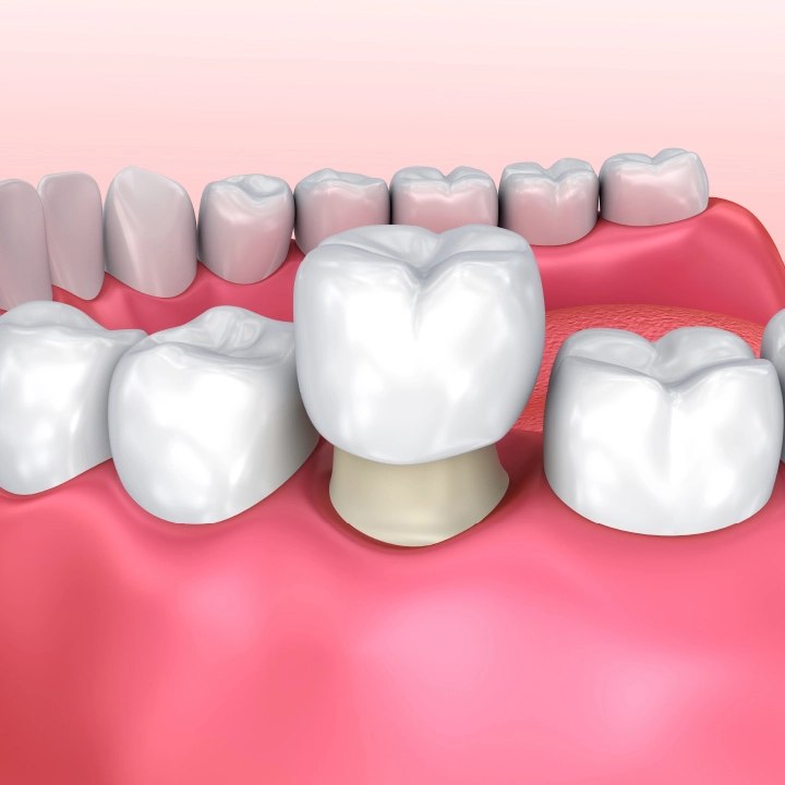 Porcelain Veneers