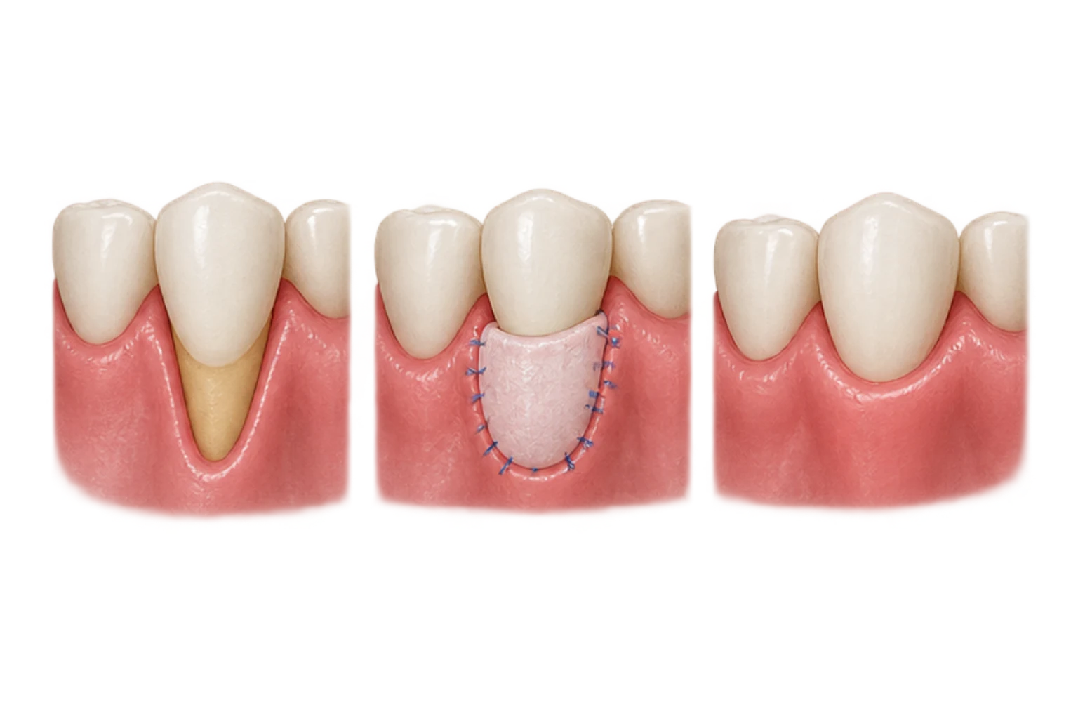 gum graft procedures