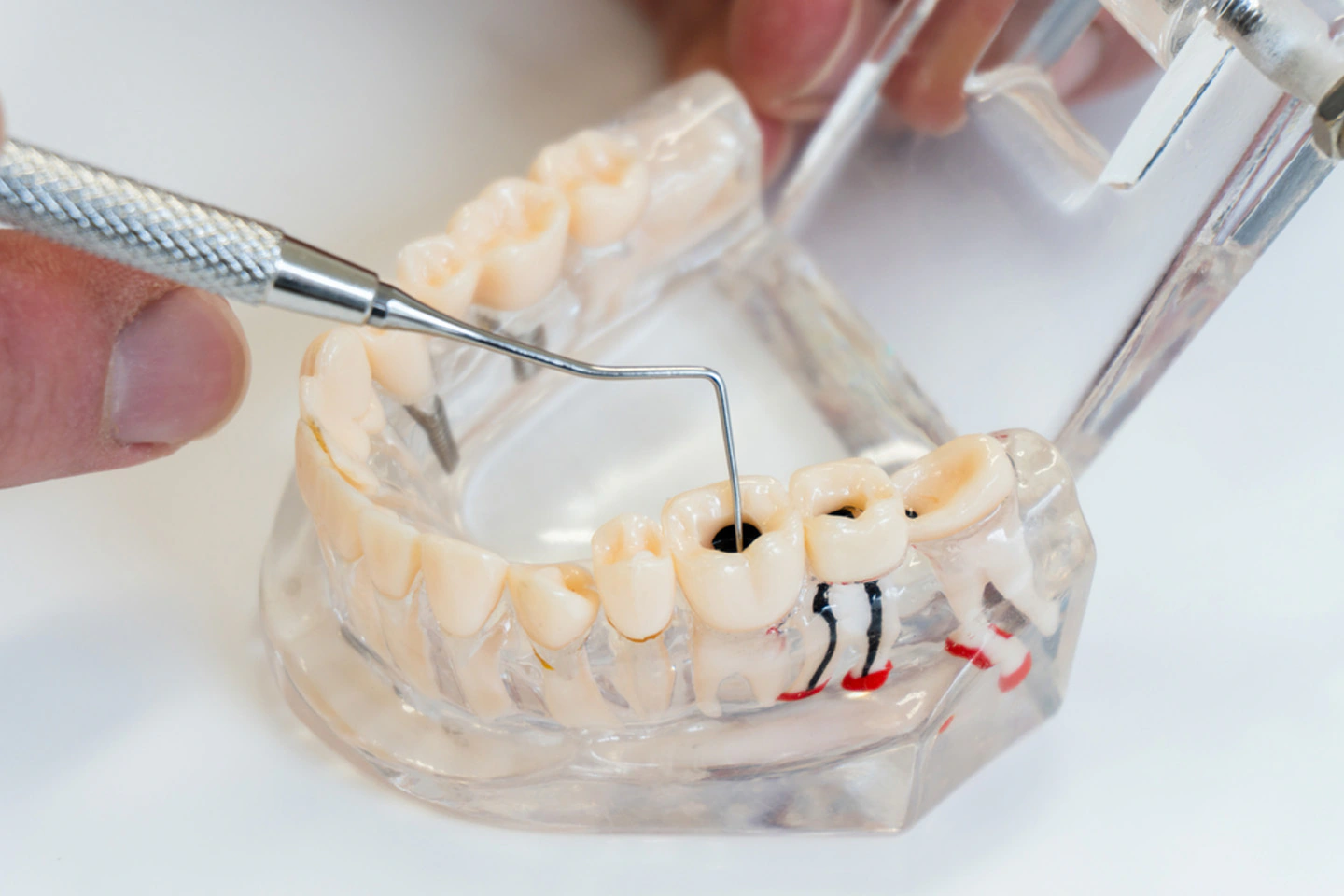 Preventing tooth decay with oral hygiene in Ripon CA