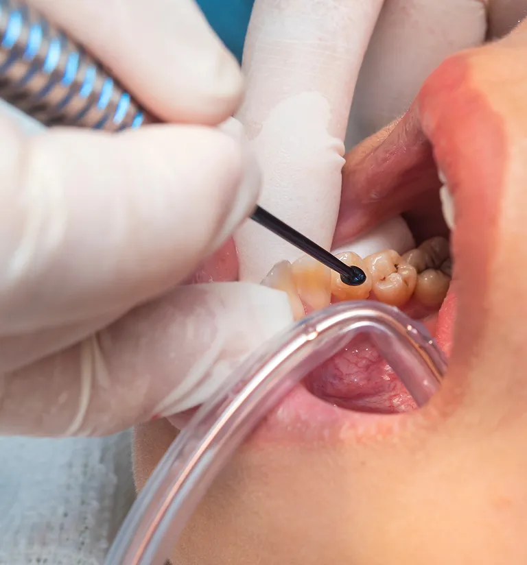 How Do All-On-4 Dentures Work?