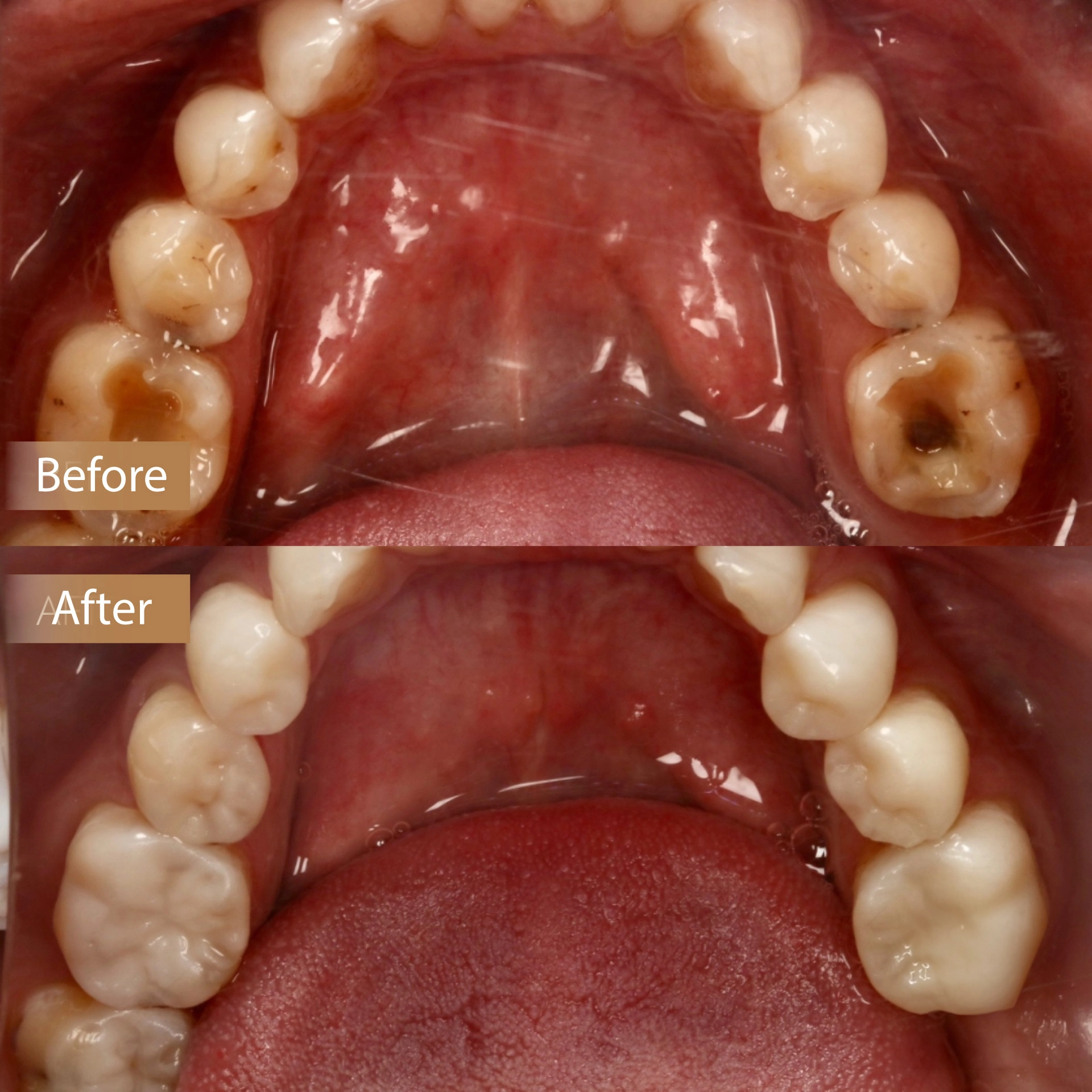 Restoring Back Teeth