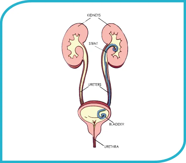 Ureteric DJ Stenting-